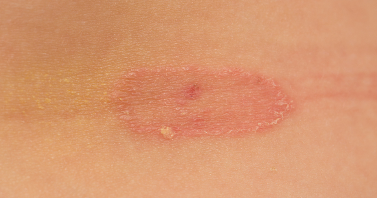 Untreated Athlete's Foot — Is it really a big deal?